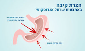 ניתוח שרוול קיבה - גסטרו פרטי