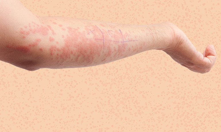 דלקת עור ממגע, אלרגיה בעור - רופא עור מומחה לאלרגיה בעור