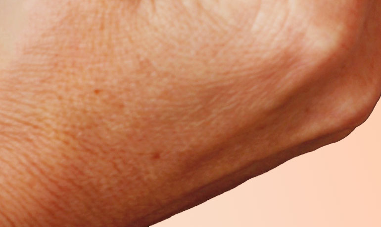 לימפומות של העור - רופא עור מומחה ללימפומות של העור